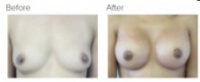 Breast Augmentation (Implants) Los Angeles with Dr. Kenneth Hughes