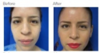 Rhinoplasty Los Angeles with Dr. Kenneth Hughes