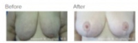 Breast Augmentation and Lift Los Angeles with Dr. Kenneth Hughes