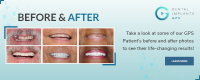Dental Implants GPS zygomatic implant