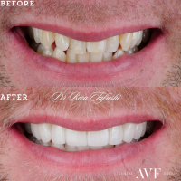 smile Before and after