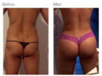 Liposuction with Dr. Kenneth Hughes