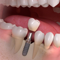 Implant placement and restoration