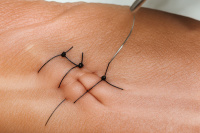 Laceration repair in Livingston, Texas
