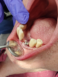 Dental Implant and Healing Abutment
