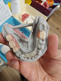 Cast Metal Partial Denture