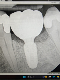 Dental Impant and Crown Delivered