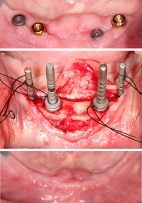 Foothill Dental specialty-Implant 62 Years old male