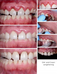 Gum Grafting-OHI