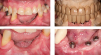 Foothill Dental specialty-FGG on Mandibular Implants