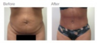 Tummy Tuck Los Angeles with Dr. Kenneth Hughes