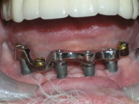 Dental implant appliance