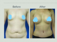 Mommy Makeover with Tummy Tuck and Breast Augmentation with Dr. Kenneth Hughes