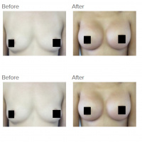 Breast augmentation with Dr. Kenneth Hughes