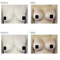 Breast augmentation with Dr. Kenneth Hughes