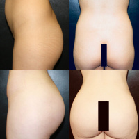 Liposuction and Brazilian Buttlift  with Dr. Kenneth Hughes