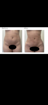 Liposuction 360 with Dr. Kenneth Hughes