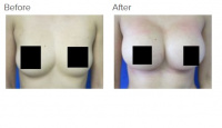 Breast Augmentation with Dr. Kenneth Hughes