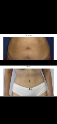 Tummy Tuck with Dr. Kenneth Hughes