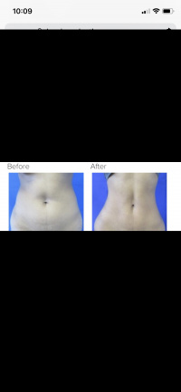 Liposuction 360 with Dr. Kenneth Hughes
