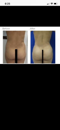 Liposuction and Brazilian buttlift or BBL with Dr. Kenneth Hughes