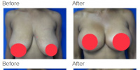 Breast Augmentation and Breast Lift with Dr. Kenneth Hughes