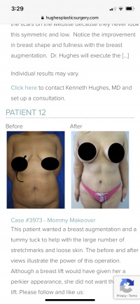 Mommy Makeover with Tummy Tuck and Breast Augmentation with Dr. Kenneth Hughes