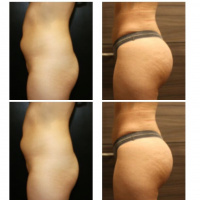 Liposuction and Brazilian buttlift or BBL with Dr. Kenneth Hughes