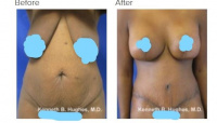 Mommy Makeover with Tummy Tuck, Breast Augmentation, and Breast Lift  with Dr. Kenneth Hughes