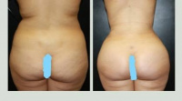 Liposuction 360 and Brazilian Buttlift or BBL with Dr. Kenneth Hughes