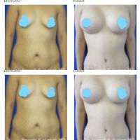 Mommy Makeover with Tummy Tuck and Breast Augmentation with Dr. Kenneth Hughes