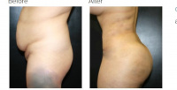 Liposuction 360 and Brazilian Buttlift or BBL with Dr. Kenneth Hughes