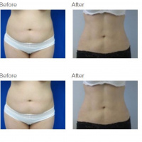 Liposuction 360 with Abdominal Sculpting with Dr. Kenneth Hughes
