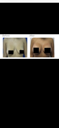 Breast Augmentation and Breast Lift with Dr. Kenneth Hughes