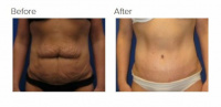 Tummy Tuck after Massive Weight Loss with Dr. Kenneth Hughes