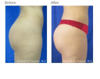 Liposuction 360 and Brazilian Buttlift or BBL with Dr. Kenneth Hughes