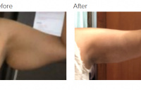 Liposuction of Arm with Bodytite for Skin Tightening with Dr. Kenneth Hughes