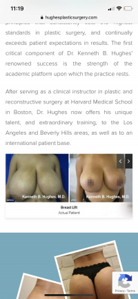 Breast Reduction with Dr. Kenneth Hughes