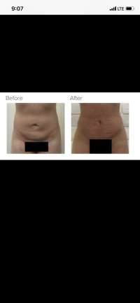 Liposuction Revision with Bodytite with Dr. Kenneth Hughes