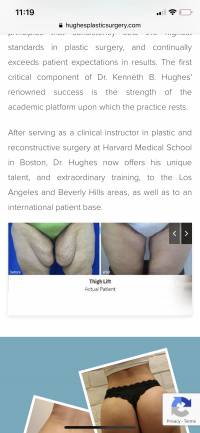 Thigh Lift with Dr. Kenneth Hughes