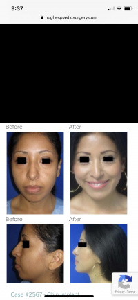 Rhinoplasty or Nose Surgery with Dr. Kenneth Hughes