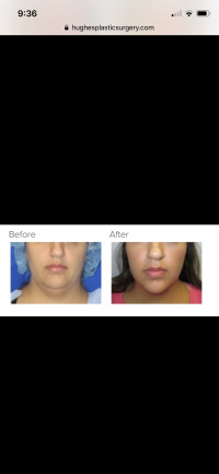 Neck Lift with Dr. Kenneth Hughes