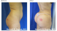 Liposuction 360 and Brazilian buttlift or BBL with Dr. Kenneth Hughes