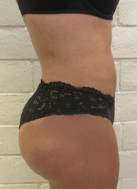 After Buttock Augmentation and Liposuction with Dr. Kenneth Hughes
