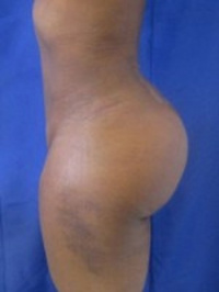 After Liposuction and Brazilian buttlift (BBL) with Dr. Kenneth Hughes
