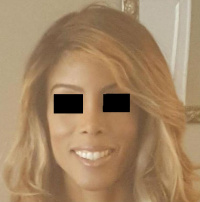 After Rhinoplasty (African American Rhinoplasty) with Dr. Kenneth Hughes