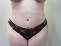 Postop Tummy Tuck with Dr. Kenneth Hughes