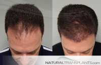 hair transplant cost