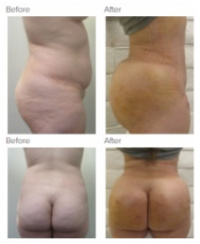 Brazilian Butt Lift with Dr. Kenneth Hughes