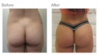 Brazilian Butt Lift with Dr. Kenneth Hughes